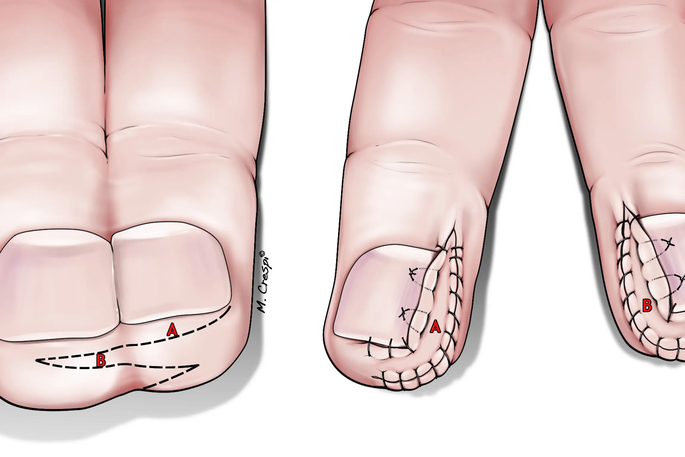 Lappeplastikk ved syndactyli