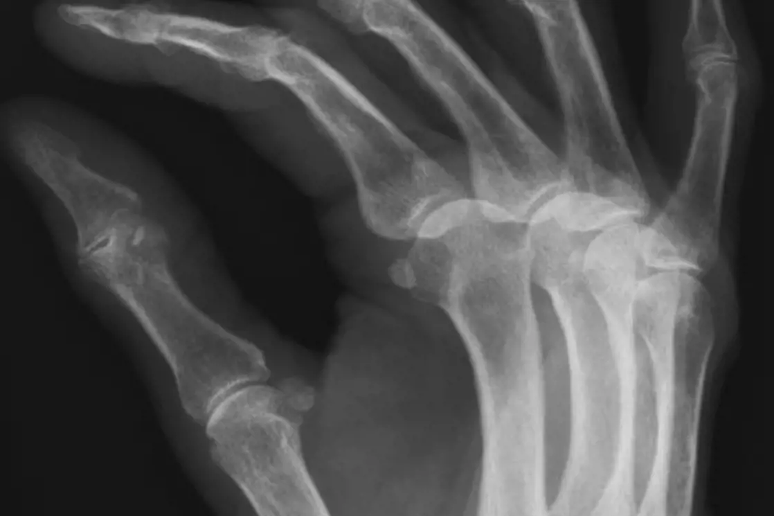 Røntgenbilde av en hånd med tommelrotslitasje